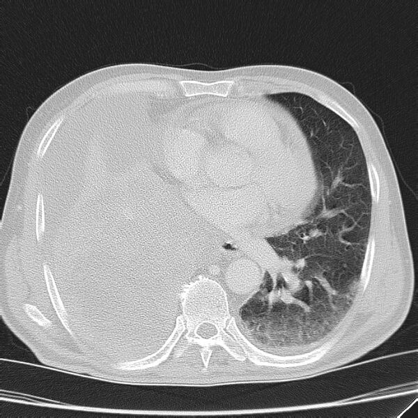 File:Non small-cell lung cancer (Radiopaedia 24467-24769 lung window 31).jpg