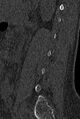 Normal CT lumbar spine (Radiopaedia 53981-60118 Sagittal bone window 76).jpg