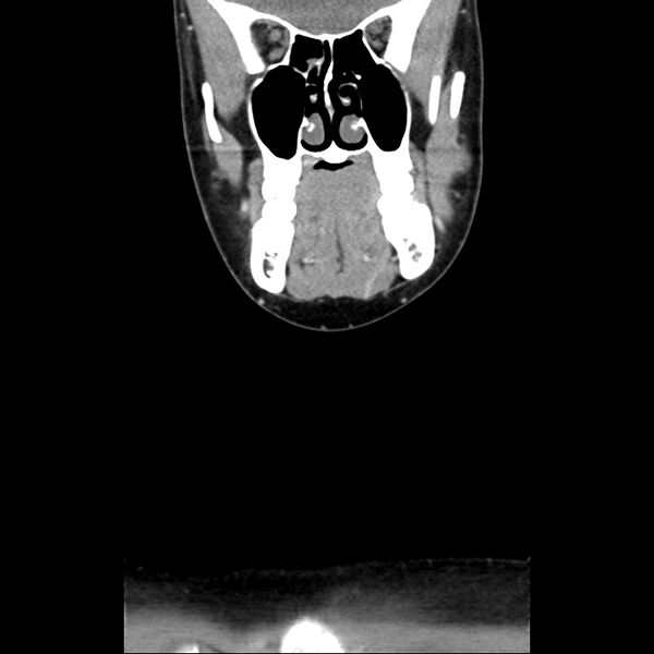File:Normal CT of the neck (Radiopaedia 14575-14500 Coronal C+ 14).jpg
