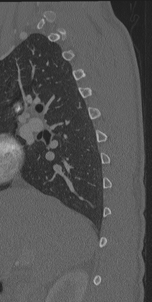 File:Normal CT thoracic spine (Radiopaedia 40181-42688 Sagittal bone window 58).png