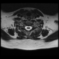 Normal cervical and thoracic spine MRI (Radiopaedia 35630-37156 Axial T2 10).png