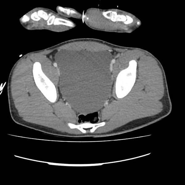 File:Normal dual-phase trauma CT chest,abdomen and pelvis (Radiopaedia 48092-52899 A 102).jpg