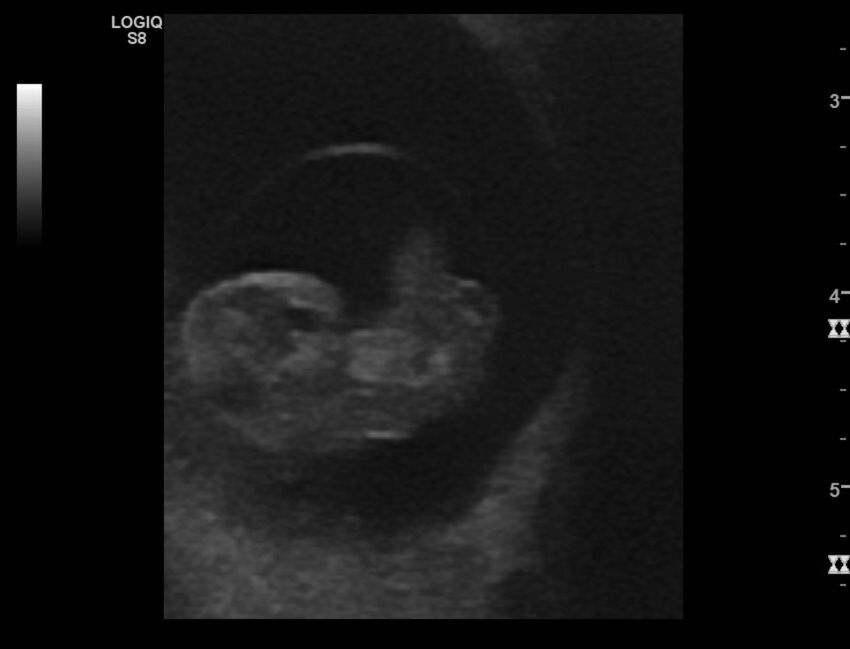 Normal early pregnancy - 8w0d (Radiopaedia 44715-48492 Longitudinal 57).jpg