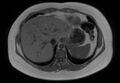 Normal liver MRI with Gadolinium (Radiopaedia 58913-66163 Axial T1 in-phase 26).jpg