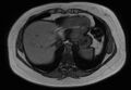 Normal liver MRI with Gadolinium (Radiopaedia 58913-66163 B 28).jpg