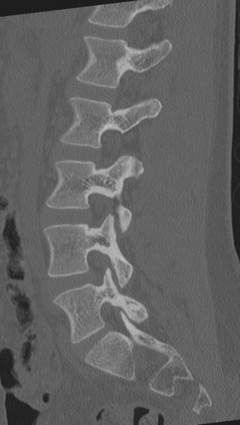 File:Normal lumbar spine CT (Radiopaedia 46533-50986 Sagittal bone window 40).png