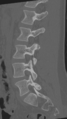 Normal lumbar spine CT (Radiopaedia 46533-50986 Sagittal bone window 40).png
