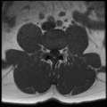 Normal lumbar spine MRI (Radiopaedia 35543-37039 Axial T1 21).png