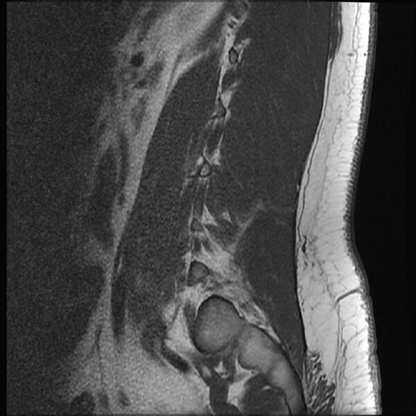 File:Normal lumbar spine MRI (Radiopaedia 43051-46311 Sagittal T1 3).jpg
