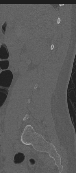 File:Normal lumbosacral CT (Radiopaedia 37923-39867 Sagittal bone window 74).png