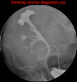 Normal retrograde pyelography of a native and transplant kidney (Radiopaedia 40480-43054 Transplant kidney 23).jpg