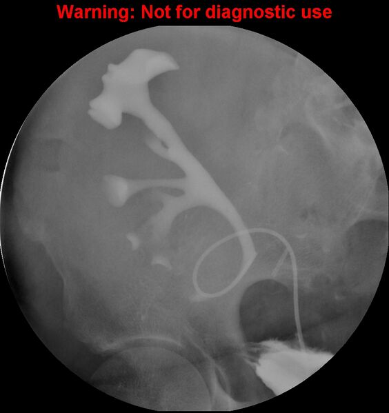 File:Normal retrograde pyelography of a native and transplant kidney (Radiopaedia 40480-43054 Transplant kidney 23).jpg