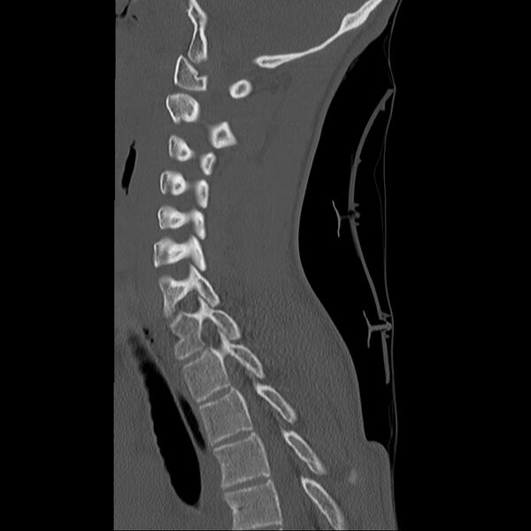File:Normal trauma spine imaging (age 16) (Radiopaedia 45335-49358 Sagittal bone window 14).jpg
