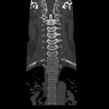 Occipital condyle fracture (Radiopaedia 31755-32691 Coronal bone window 13).jpg