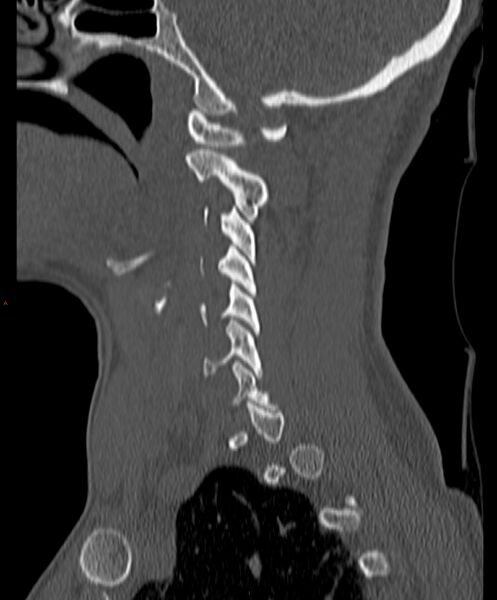 File:Occipital condyle fracture (Radiopaedia 61165-69056 Sagittal bone window 9).jpg