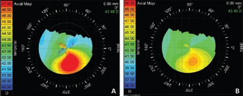 Topography of individual with keratoconus a) having steps 0.5 D and b) having steps of 1.0 D