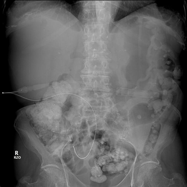 File:Peritoneal dialysis catheter (Radiopaedia 74397).jpg