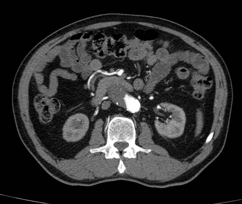 Abdominal aortic aneurysm (Radiopaedia 22421-22458 C+ arterial phase 36).jpg