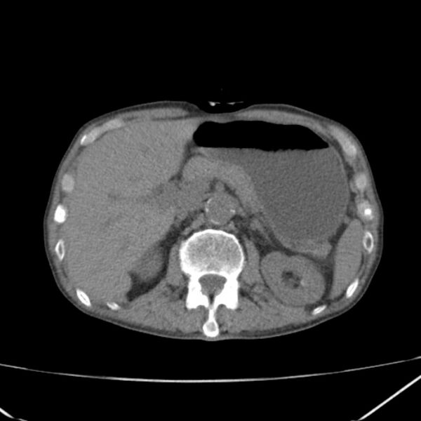 File:Abdominal aortic aneurysm (Radiopaedia 23703-23856 Axial non-contrast 16).jpg
