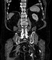 Abdominal aortic aneurysm (Radiopaedia 25855-26001 Coronal C+ arterial phase 60).jpg