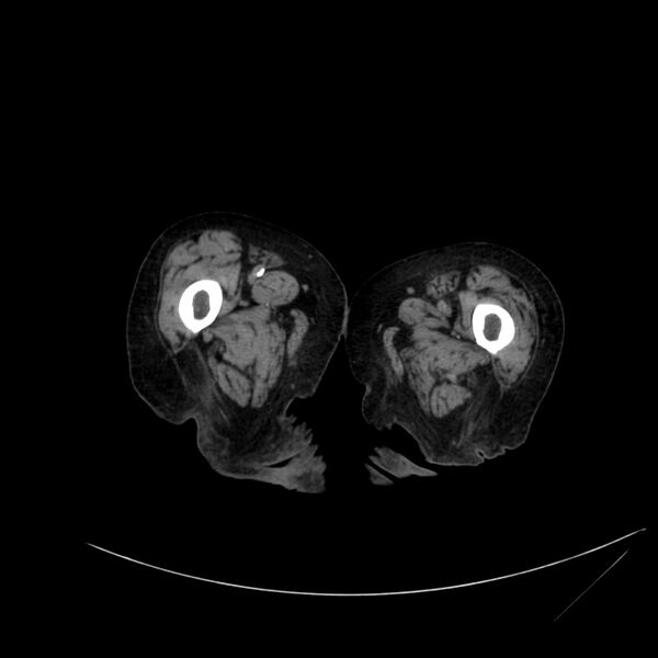 File:Abdominal aortic aneurysm - impending rupture (Radiopaedia 19233-19246 Axial non-contrast 153).jpg