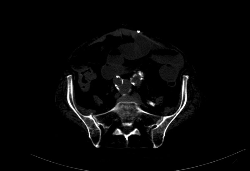 File:Abdominal aortic aneurysm - impending rupture (Radiopaedia 19233-19246 B 40).jpg