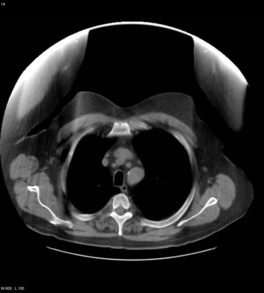 Abdominal aortic aneurysm with intramural hematoma then rupture (Radiopaedia 50278-55631 Axial non-contrast 10).jpg