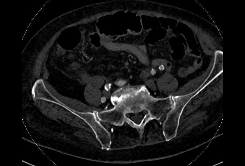 File:Abdominal aortic aneurysm with thrombus fissuration (Radiopaedia 73192-83919 Axial C+ arterial phase 160).jpg