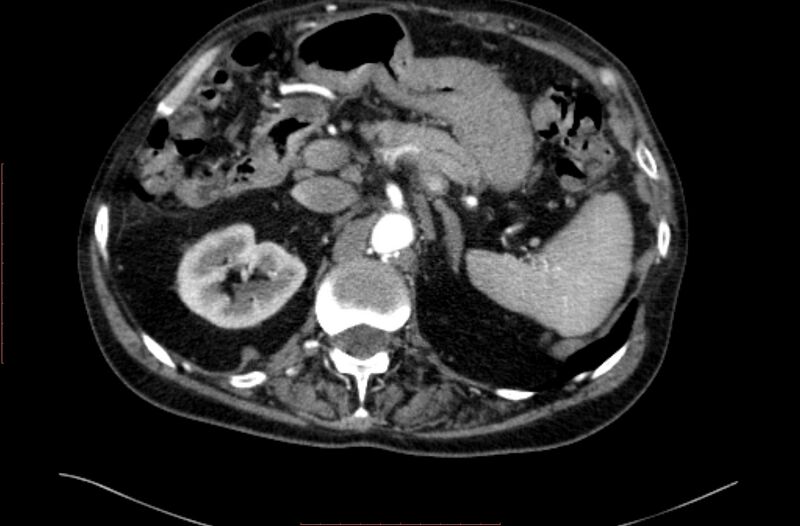 File:Abdominal aortic interposition tube graft and aneurysm thrombosis (Radiopaedia 71438-81857 Axial C+ arterial phase 24).jpg