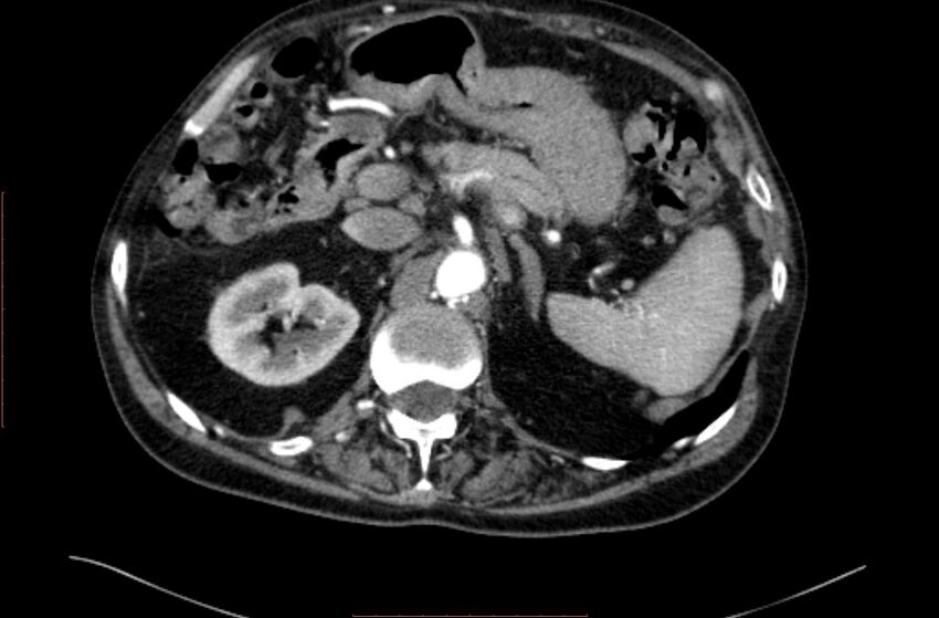 Abdominal aortic interposition tube graft and aneurysm thrombosis (Radiopaedia 71438-81857 Axial C+ arterial phase 24).jpg