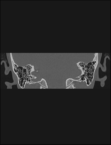 File:Aberrant right internal carotid artery (Radiopaedia 65191-74198 Coronal non-contrast 62).jpg
