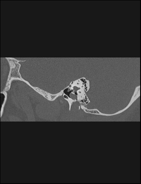 File:Aberrant right internal carotid artery (Radiopaedia 65191-74198 Sagittal non-contrast 50).jpg
