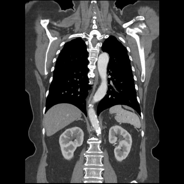 File:Aberrant right subclavian and left vertebral arteries (Radiopaedia 43467-46847 Coronal C+ portal venous phase 60).jpg