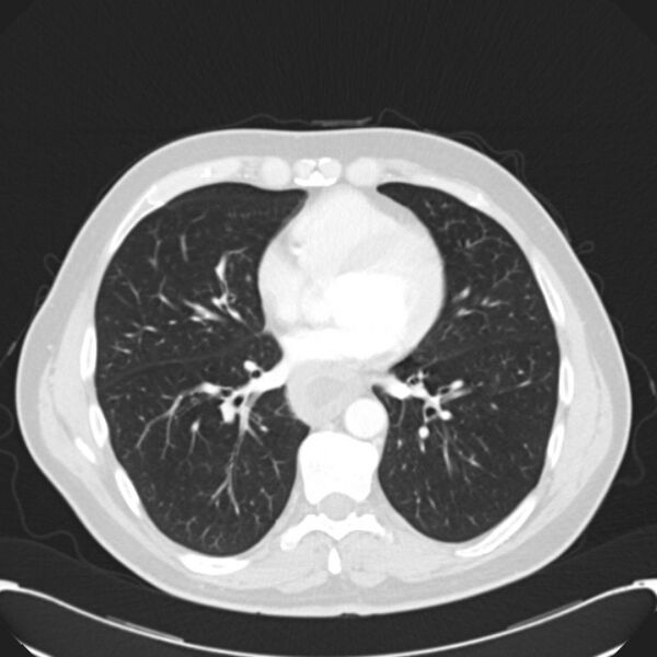 File:Achalasia (Radiopaedia 24937-25206 Axial lung window 21).jpg