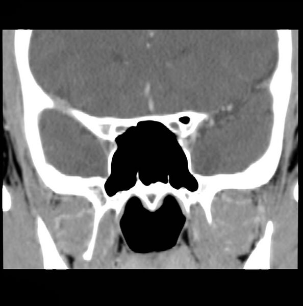 File:Acinic cell carcinoma of the lacrimal gland (Radiopaedia 9480-10160 Coronal C+ arterial phase 11).jpg