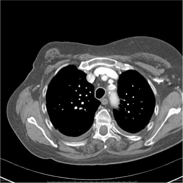 File:Acute-on-chronic pulmonary emboli (Radiopaedia 27925-28169 C+ CTPA 20).jpg