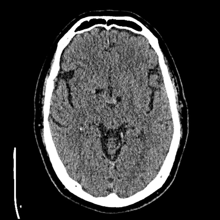 Acute A3 occlusion with ACA ischemic penumbra (CT perfusion) (Radiopaedia 72036-82525 Axial non-contrast thins 19).jpg