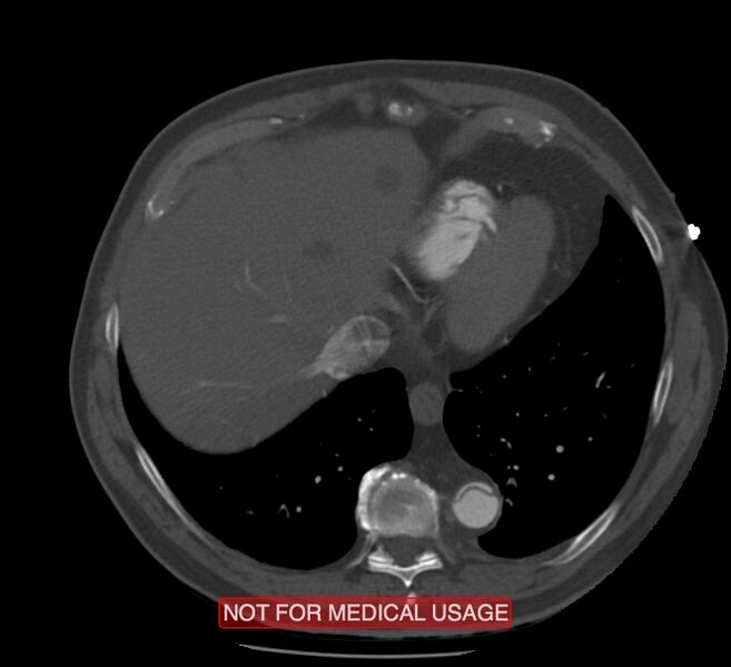 File:Acute aortic dissection - Stanford type A (Radiopaedia 40661-43285 Axial C+ arterial phase 59).jpg