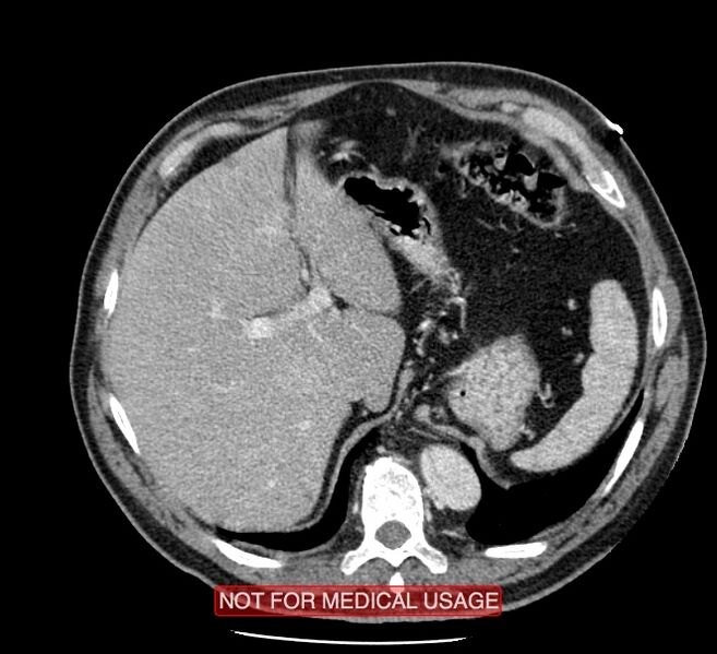 File:Acute aortic dissection - Stanford type A (Radiopaedia 40661-43285 Axial C+ portal venous phase 64).jpg