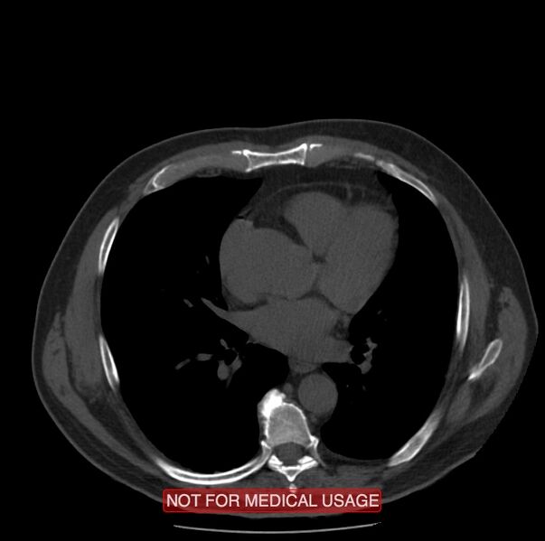 File:Acute aortic dissection - Stanford type A (Radiopaedia 40661-43285 Axial non-contrast 34).jpg