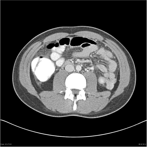 File:Acute appendicitis (Radiopaedia 25364-25615 B 32).jpg