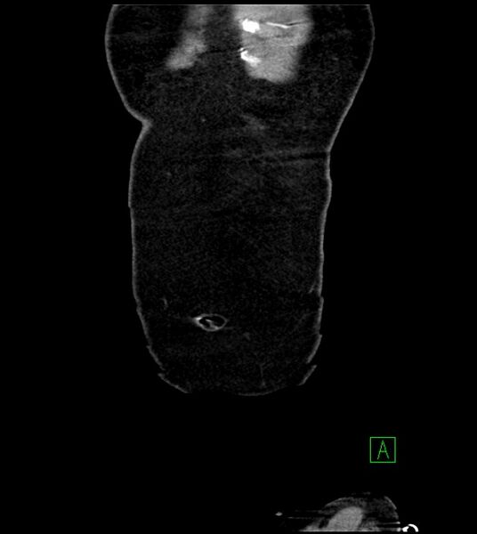 File:Acute arterial mesenteric ischemia (Radiopaedia 78238-90828 Coronal C+ portal venous phase 11).jpg