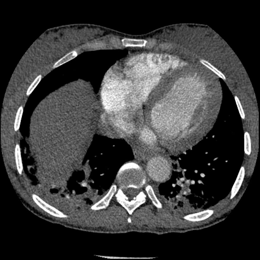 Acute chest syndrome - sickle cell disease (Radiopaedia 42375-45499 Axial C+ CTPA 138).jpg