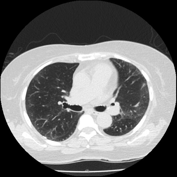 File:Acute interstitial pneumonitis (Radiopaedia 45404-49444 Axial lung window 48).jpg