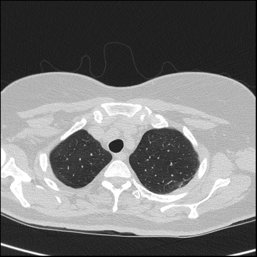 Acute interstitial pneumonitis (Radiopaedia 45404-49453 Axial lung window 15).jpg
