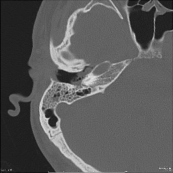 File:Acute otomastoiditis (Radiopaedia 28276-28512 Axial PTB bone window reformat 41).jpg