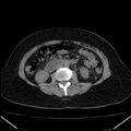 Acute pancreatitis - Balthazar C (Radiopaedia 26569-26714 Axial non-contrast 48).jpg