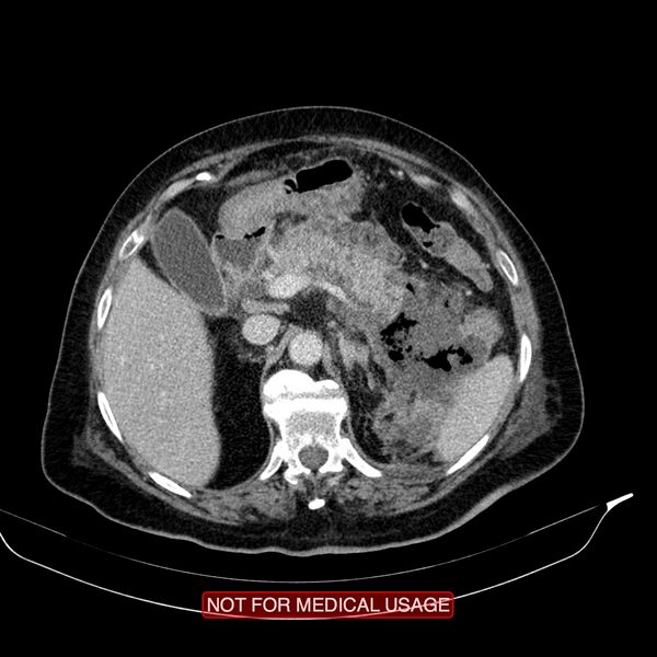 File:Acute pancreatitis with infected necrosis (Radiopaedia 26454-26585 Axial C+ portal venous phase 7).jpg