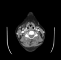 Acute parotitis (Radiopaedia 27425-27619 Axial C+ portal venous phase 42).png