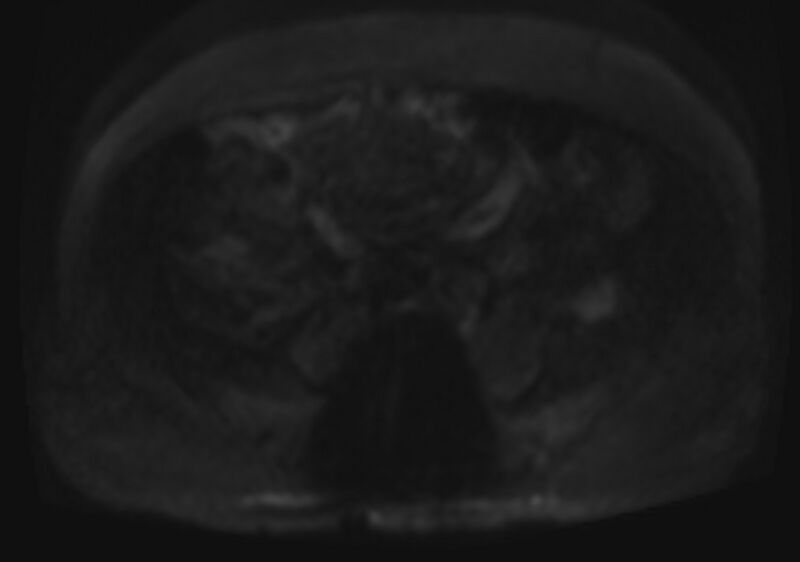 File:Acute portal vein thrombosis (Radiopaedia 73198-83925 Axial DWI 59).jpg